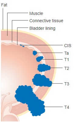 Bladder Cancer Tumor Staging