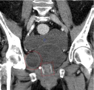 Coronal CT images demonstrating cuff (square) and PRB visible (circled). Source: Wikipedia