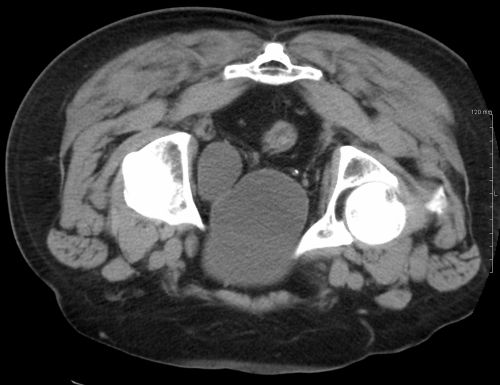 Axial CT scan demonstrating a bladder diverticulum