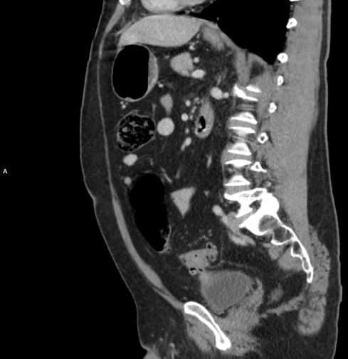 Bladder wall thickening adjacent to a loop of thickened bowel