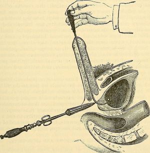 Dolbeau technique of perineal lithotomy. Dr. Dolbeau once removed a 53g calculus with this method.