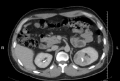 Kidney CT Mass Axial.png