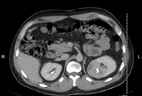 Kidney CT Mass Axial.png