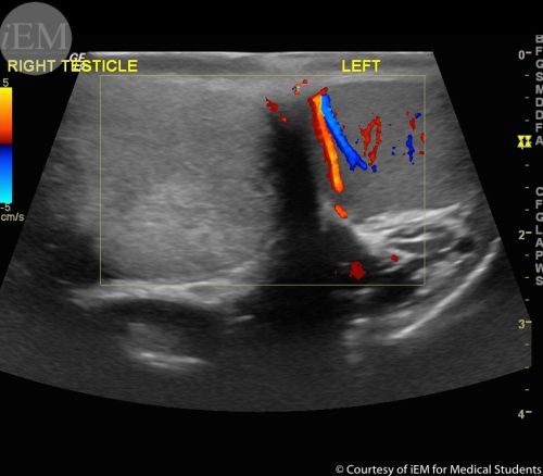Ultrasound with doppler demonstrating no flow to right testicle.