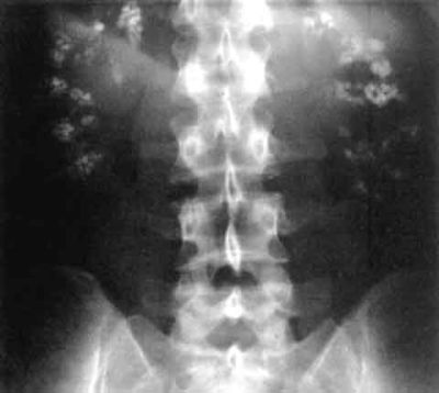 Nephrocalcinosis on plain film x-ray