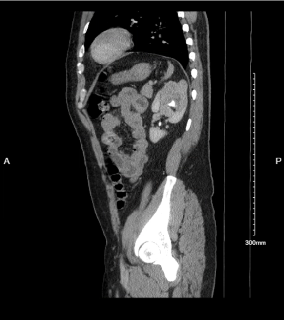 Kidney CT Mass Sagittal.png