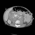 Neuroblastoma 103.jpg