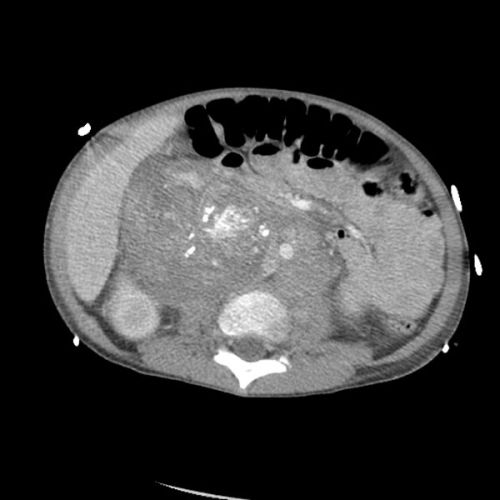 Axial CT scan of Neuroblastoma