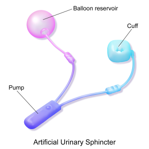 3 parts of the Artificial Urinary Sphincter: Cuff, Balloon reservoir, Pump. Source: Wikipedia