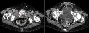 Axial CT images demonstrating cuff (circled) in left panel, and balloon reservoir visible in right panel. Source: Wikipedia